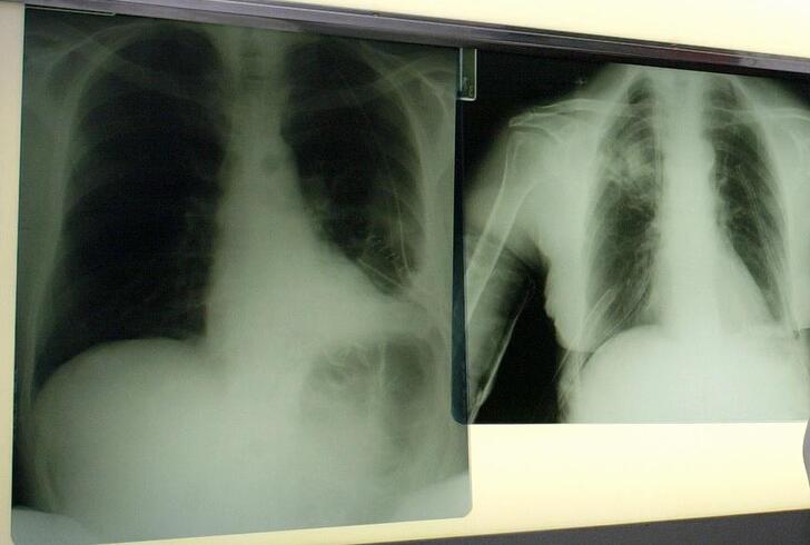 Salute, esperti: Virus sinciziale sottovalutato nonostante oltre 50mila ricoveri l'anno Salute, esperti: Virus sinciziale sottovalutato nonostante oltre 50mila ricoveri l'anno